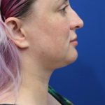 Submental Liposuction Before & After Patient #5284