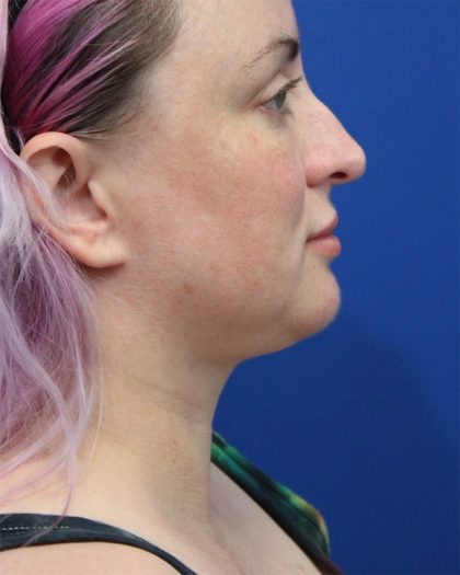 Submental Liposuction Before & After Patient #5284