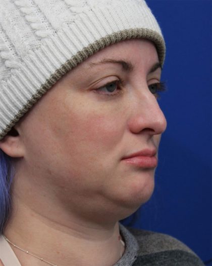 Submental Liposuction Before & After Patient #5284