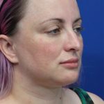 Submental Liposuction Before & After Patient #5284