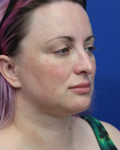 Submental Liposuction Before & After Patient #5284