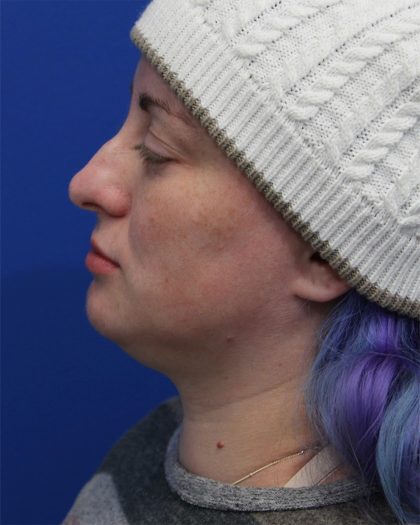 Submental Liposuction Before & After Patient #5284