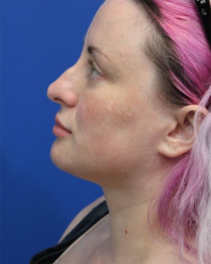 Submental Liposuction Before & After Patient #5284