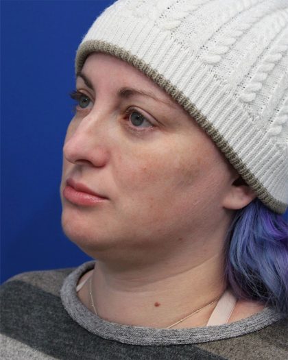 Submental Liposuction Before & After Patient #5284