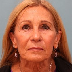 Upper Blepharoplasty Before & After Patient #5283