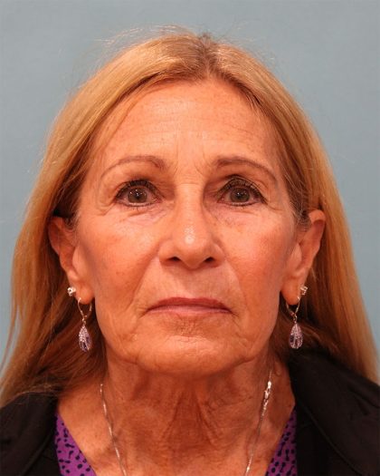 Upper Blepharoplasty Before & After Patient #5283