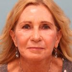 Upper Blepharoplasty Before & After Patient #5283