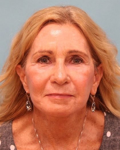 Upper Blepharoplasty Before & After Patient #5283
