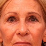 Upper Blepharoplasty Before & After Patient #5283