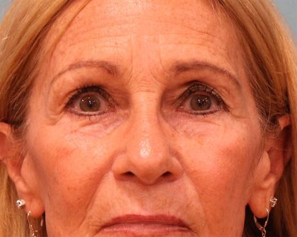 Upper Blepharoplasty Before & After Patient #5283