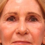 Upper Blepharoplasty Before & After Patient #5283