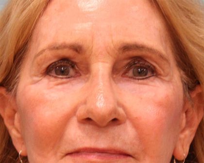 Upper Blepharoplasty Before & After Patient #5283