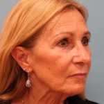 Upper Blepharoplasty Before & After Patient #5283