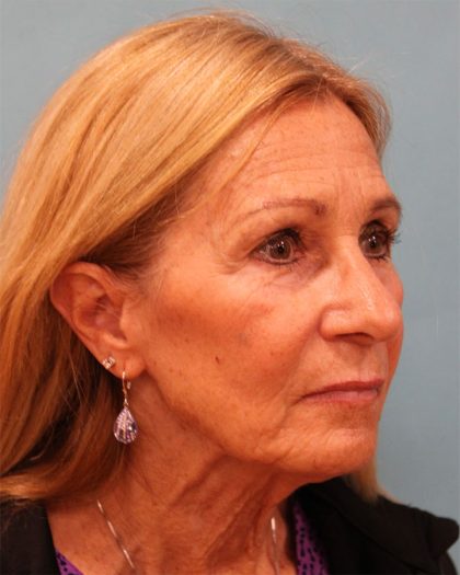 Upper Blepharoplasty Before & After Patient #5283