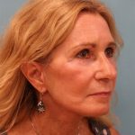 Upper Blepharoplasty Before & After Patient #5283