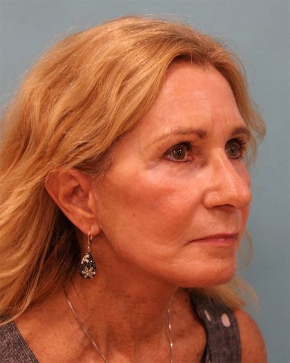 Upper Blepharoplasty Before & After Patient #5283