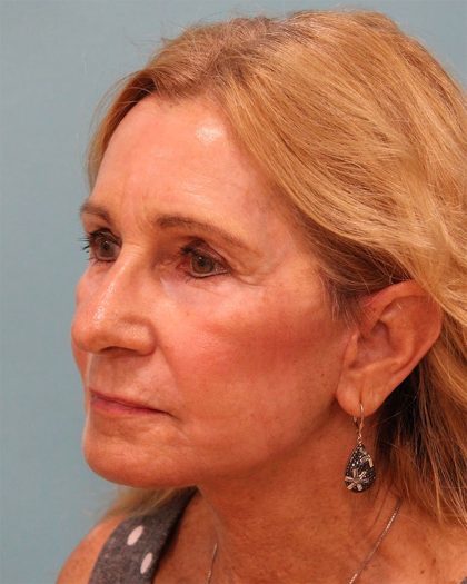 Upper Blepharoplasty Before & After Patient #5283